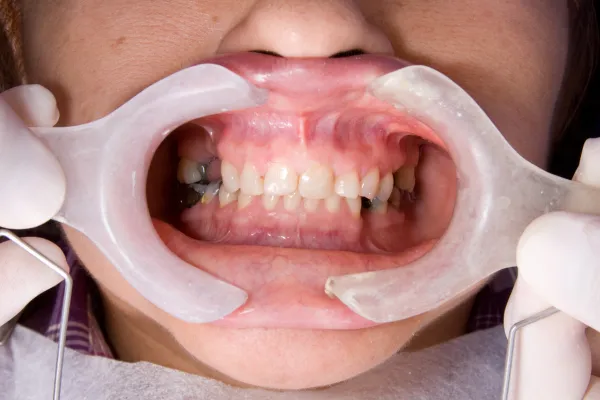Sinus Elevation Surgical Workshop